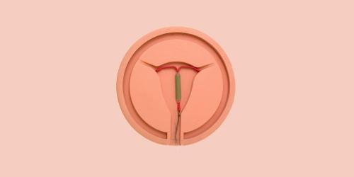 Side effects of Mirena IUD: first findings of the survey