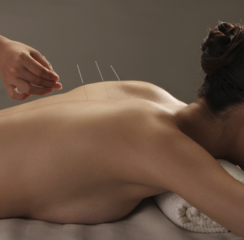 Know everything about acupuncture