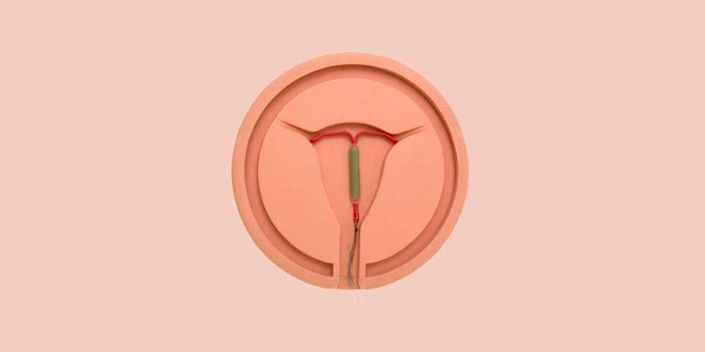 Side effects of Mirena IUD: first findings of the survey