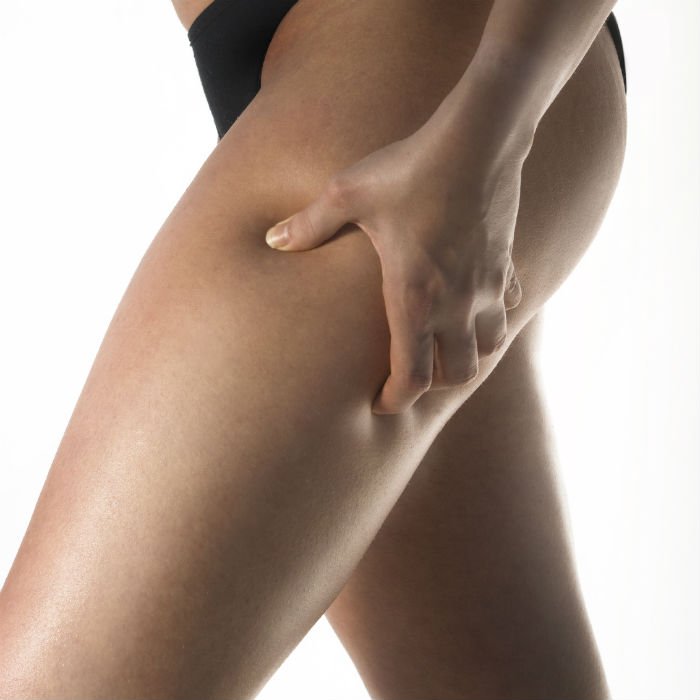 What is electrolipolysis, a technique for losing cellulite?