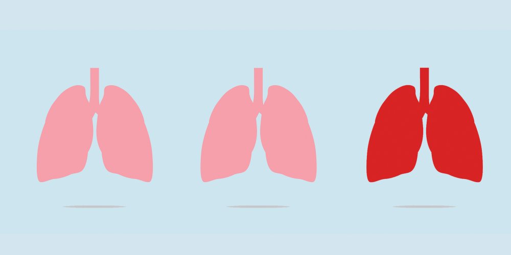 Lung cancer will soon be the deadliest in women